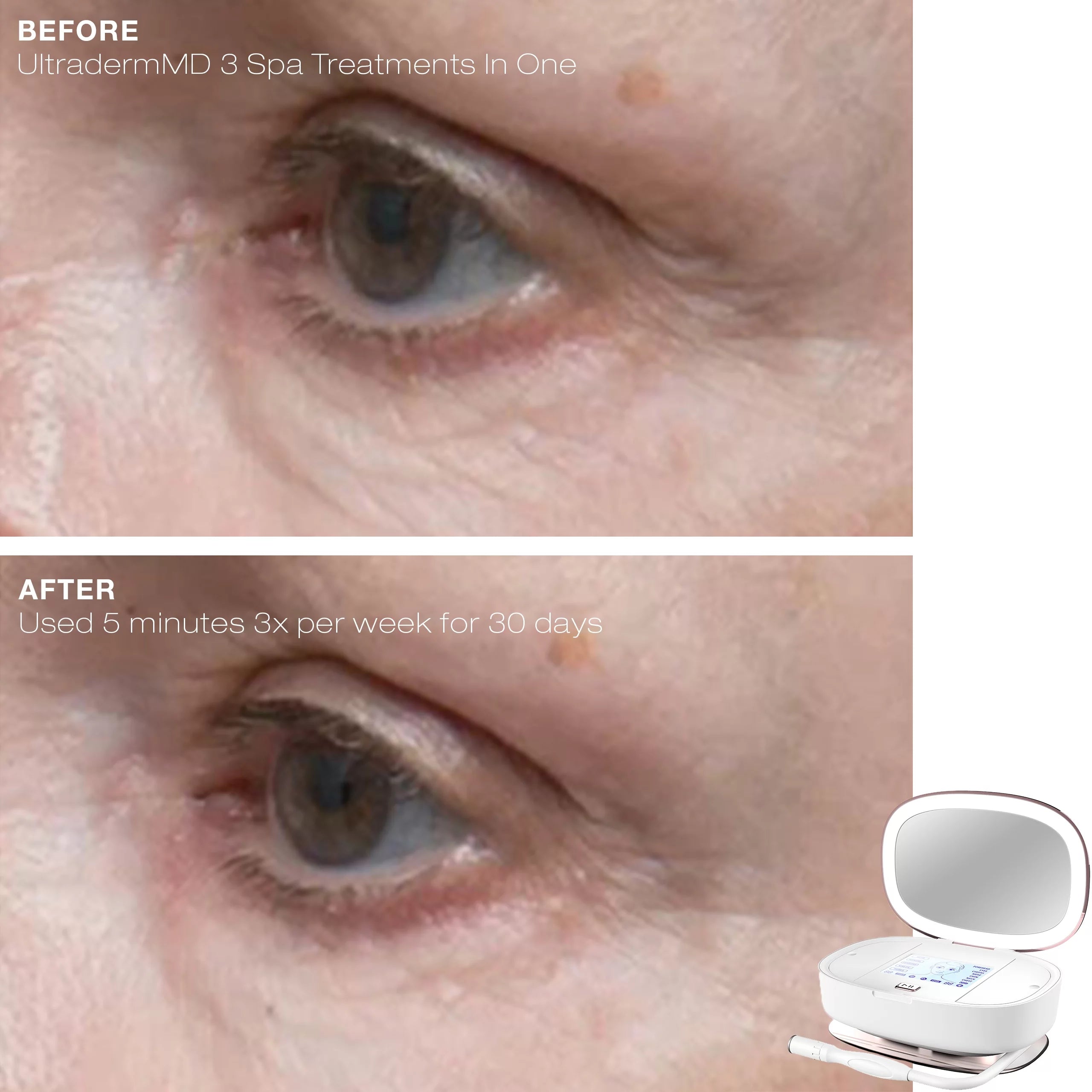 3 in 1 Microdermabrasion Machine with Diamond Tips - White F791
